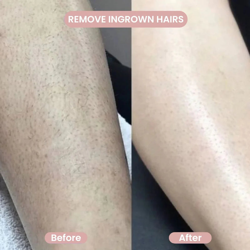 Before and after comparison of ingrown hairs on a leg.