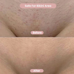 Before and after comparison of skin texture on the bikini area.