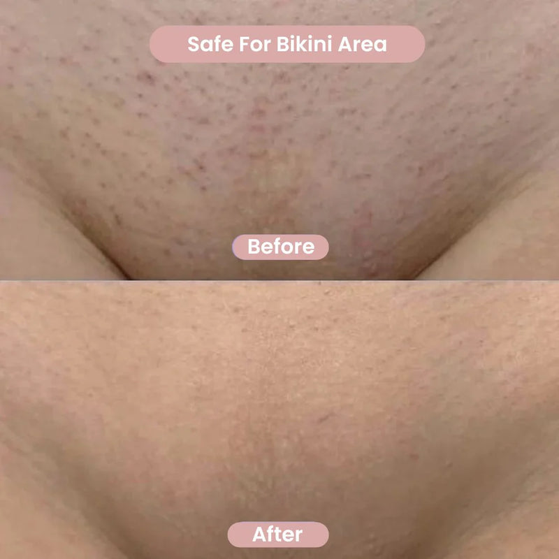 Before and after comparison of skin texture on the bikini area.