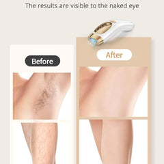 Kyvone Ice Laser Pro – Unlimited Flashes Hair Removal Device With 9 Gears
