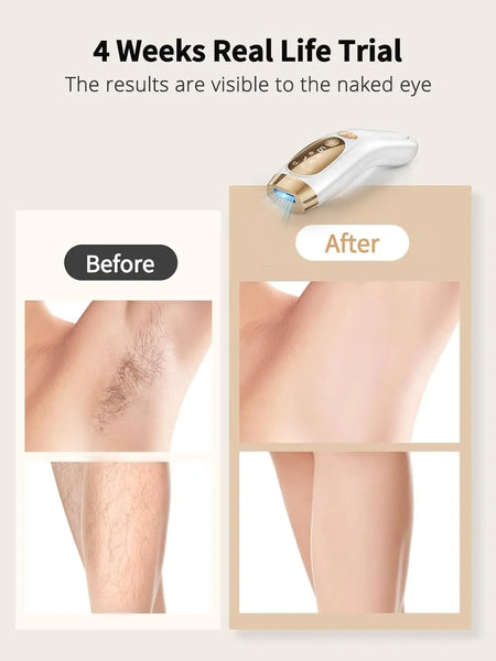 Kyvone Ice Laser Pro – Unlimited Flashes Hair Removal Device With 9 Gears