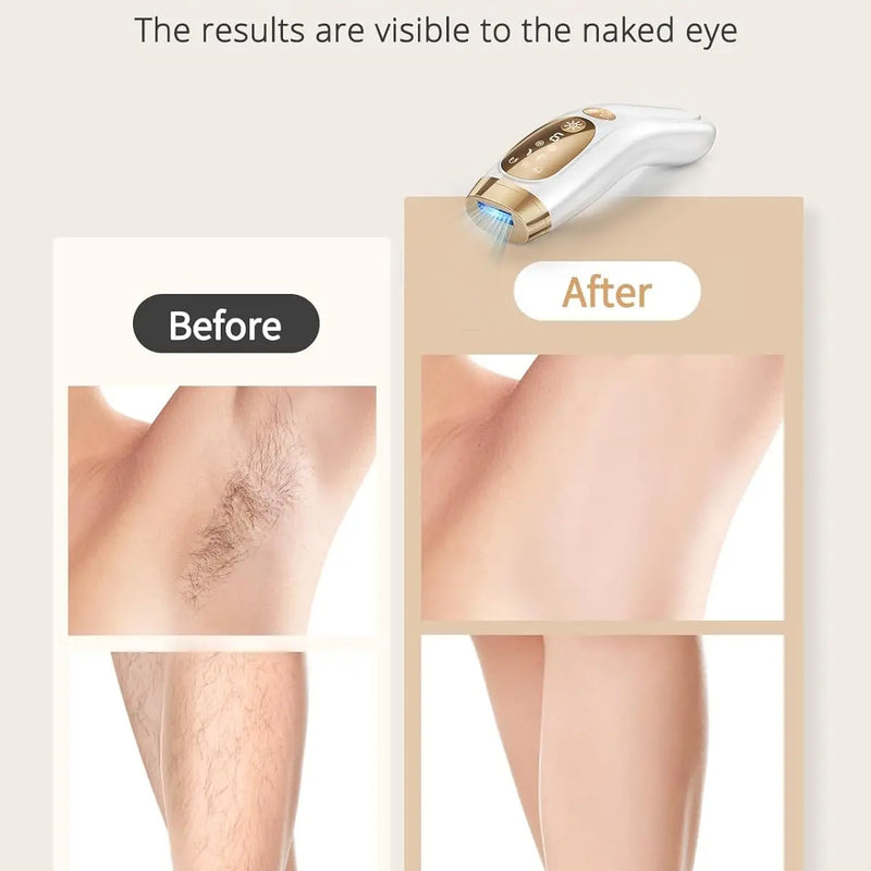 Kyvone Ice Laser Pro – Unlimited Flashes Hair Removal Device With 9 Gears